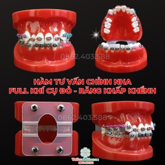Hàm tư vấn chỉnh nha full khí cụ đỏ - Răng khấp khểnh