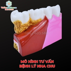 Mô hình tư vấn bệnh lý nha chu