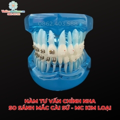 Hàm tư vấn so sánh chỉnh nha mắc cài sứ và kim loại