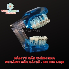Hàm tư vấn so sánh chỉnh nha mắc cài sứ và kim loại