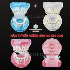 Hàm tư vấn chỉnh nha mắc cài kim loại
