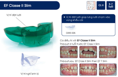 Hàm định hình khớp răng EF Line Orthoplus