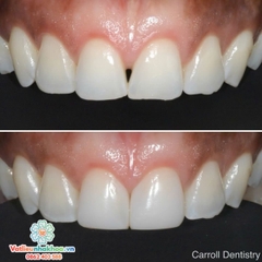 Bộ matrix hàn tam giác đen và khe thưa (matric)