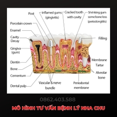 Mô hình tư vấn bệnh lý nha chu