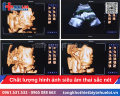 Hệ thống siêu âm bàn đẩy cao cấp Edan Acclarix LX85