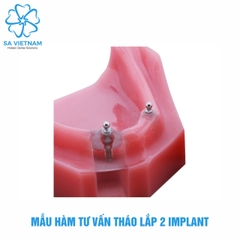 Hàm tư vấn tháo lắp 2 implant