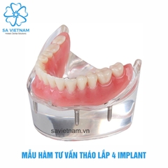Hàm tư vấn tháo lắp 4 implant
