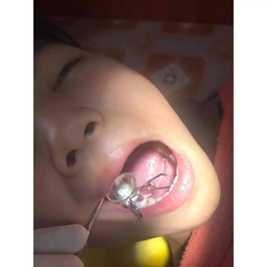 Bộ Matric Kèm Chêm nha khoa (matrix)