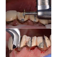 Bẩy tách mão chữ thập