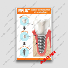 Tranh Implant nha khoa công nghệ cao - MS07