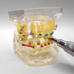 Hàm tư vấn chỉnh nha full khí cụ có nhổ răng