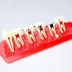 Hàm tư vấn các giai đoạn sâu răng