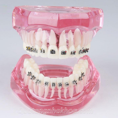 Hàm tư vấn chỉnh nha mắc cài kim loại