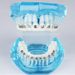 Hàm tư vấn chỉnh nha mắc cài kim loại