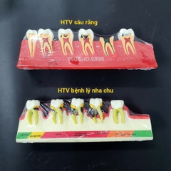 Hàm tư vấn các giai đoạn sâu răng