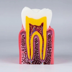 Mô hình tư vấn răng khỏe, răng sâu