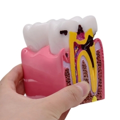 Mô hình tư vấn răng khỏe, răng sâu