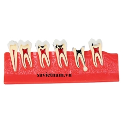 Hàm tư vấn các giai đoạn sâu răng