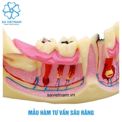 Mẫu hàm tư vấn Sâu răng trong Nha khoa