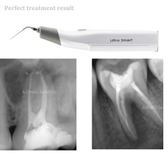 Máy Rung Rửa Nội Nha Coxo Ultra Smart