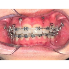 Minivis chỉnh nha Hàn Quốc TFIT