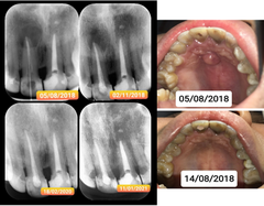 Vật liệu trám bít ống tủy OrthoMTA- Hàn Quốc