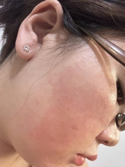 Da sau peel bị đỏ ngứa, sần sùi... còn 15 ngày nữa cưới rồi cứu em với! 😭
