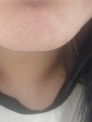 Da sẹo rỗ lâu năm thế này có cứu được không các chị, em stress quá chẳng dám đi đâu! 😭