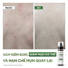 Xịt giảm mụn và mờ thâm cơ thể Exfoliating Body Spray 100ml