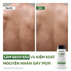 Sữa tắm tẩy tế bào chết & giảm mụn lưng Exfoliating Body Wash 250ml