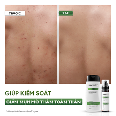 Combo Sữa tắm mụn lưng 250ml và Xịt mụn lưng 100ml