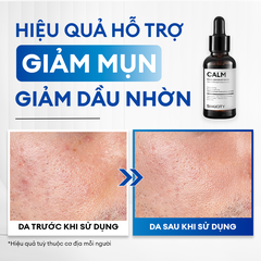Combo Acne Trio chăm da dầu mụn: Sữa rửa mặt 100g, Serum Calm 30ml, Kem dưỡng ẩm 80g