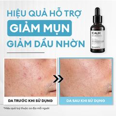 Serum Calm giảm mụn kiềm dầu BHA + phức hợp thảo mộc 10ml