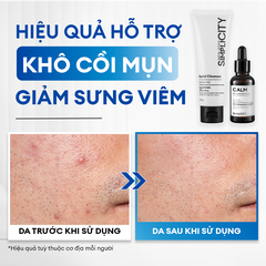 Combo Acne Duo giảm mụn sưng viêm: Sữa rửa mặt 100g và Serum Calm 30ml