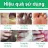 thuoc-tay-mun-coc-kem-tay-not-ruoi-mu-n-co-c