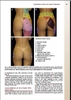 Sách gluteal Augmentation, An Issue of Clinics in Plastic Surgery (The Clinics: Surgery)