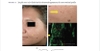 Sách ACNE SCARS:Classification and Treatment