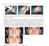 Sách Miniinvasive Face and Body Lifts Closed Suture Lifts or Barbed Thread Lifts
