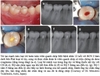 Sách tiên lượng điều trị nội nha