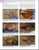 Sách  Principles and Practice of Lymphedema Surgery