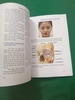BIẾN CHỨNG DO TIÊM FILLER