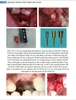 IMPLANT TRONG THỰC HÀNH NHA KHOA
