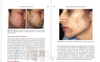 Sách  Step by Step Treatment of Acne Scars 