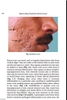 Sách  Step by Step Treatment of Acne Scars 