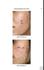 Sách  Step by Step Treatment of Acne Scars 