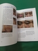 BIẾN CHỨNG DO TIÊM FILLER