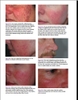 Sách acne: causes and practical management