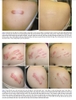 KIỂM SOÁT SẸO BẰNG PHƯƠNG PHÁP SỬ DỤNG TIA LASER