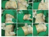 Sách liposuction 1st ed. 2018 edition
