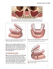 Sách phục hình toàn hàm trên implant
